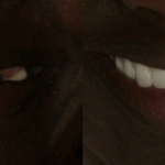 Implant Case 15 (No face) thumbnail