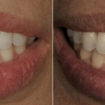 Implant Case 20 ( No face) thumbnail