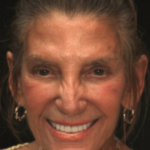Smile Gallery 10/ Full Mouth Rehab 13 thumbnail