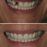 Implant case 12 (No Face) thumbnail