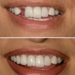 Case 11 (no Face Implant) thumbnail