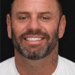 Smile Gallery 17/ Full Mouth Rehab 45 thumbnail