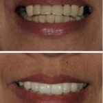 Implant Case 14 ( no Face) thumbnail