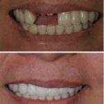 Implant case 13 (No Face) thumbnail