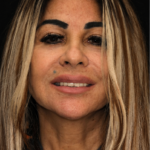 Smile Gallery 21/ Full Mouth Rehab 23 thumbnail