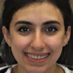 Veneer Case 22 thumbnail