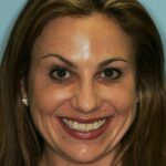 Veneer Case 8 thumbnail