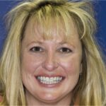 Veneer Case 11 thumbnail