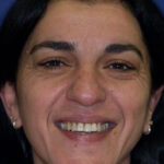 Smile Gallery 39 (Maybe)/ Full Mouth Rehab 59 thumbnail