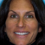 Veneer Case 10/ Full Mouth Rehab 16 thumbnail