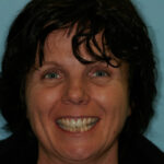 Smile Gallery 35 (Maybe)/ Full Mouth Rehab 34/ Crown Case 9 thumbnail