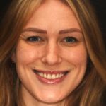 Veneer Case 38 thumbnail