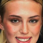 Veneer case 42/ Full Mouth Rehab 4 thumbnail