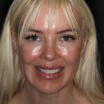 Veneer Case 40 thumbnail