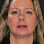 Veneer Case 31/Full Mouth Rehab 51 thumbnail