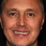 Veneer Case 43/ Full Mouth Rehab 14 thumbnail