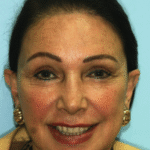 Veneer case 19/ Full Mouth Rehab 25 thumbnail