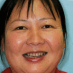 Veneer case 16/ Full Mouth rehab 35 thumbnail