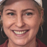 Veneer Case 21 thumbnail