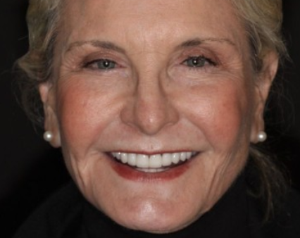 Laguna Beach female patient after undergoing an age-defying smile makeover.