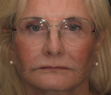 Laguna Beach female patient before undergoing an age-defying smile makeover.