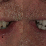 Bridge Case 16 thumbnail