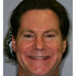 Crown Case 1/ Full mouth Rehab 61 thumbnail