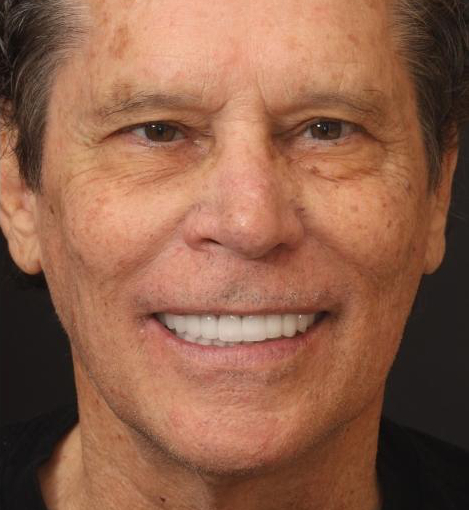 Orange County patient after undergoing a full smile makeover.