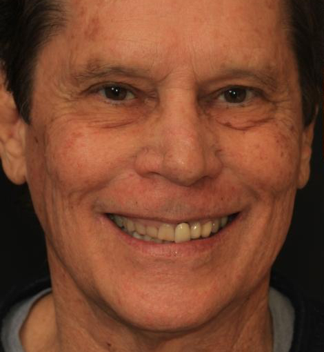 Orange County patient before undergoing a full smile makeover.