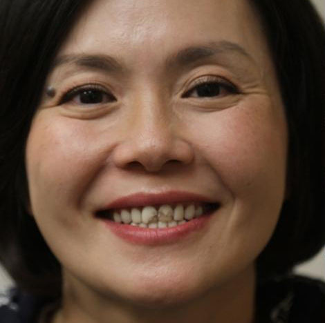 Newport Beach patient before undergoing a full cosmetic smile makeover