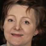 Full Mouth Rehab 56 thumbnail