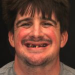 Travis Implant thumbnail