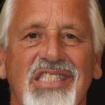 Full Mouth Rehab 54 thumbnail