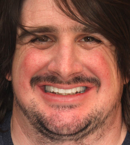 Young man shows off his brand new implant supported dentures.