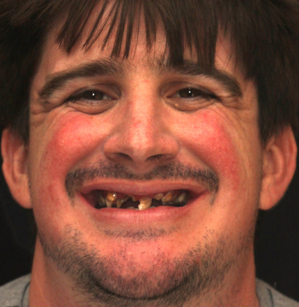 Young man with badly decayed teeth before receiving implant dentures in Irvine.