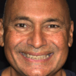 Full Mouth Rehab 8 thumbnail