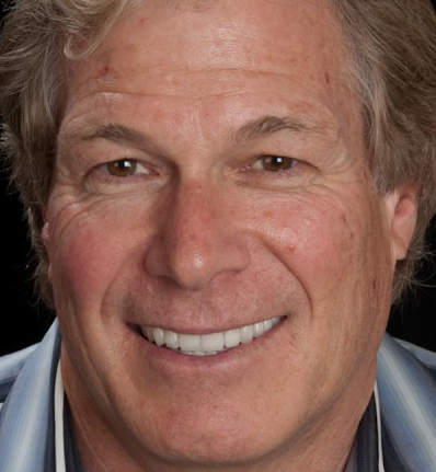 Man from Irvine shows off his wonderful smile after receiving porcelain dental veneers.
