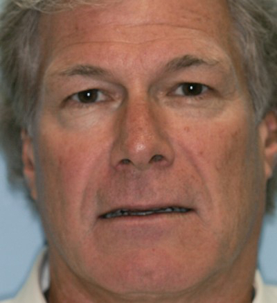 Man from Irvine before receiving porcelain dental veneers.