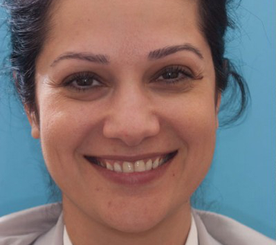 Orange County patient before receiving dental veneers.