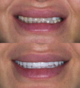 before and after of a rejuvenated smile