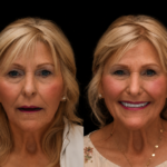 Full Mouth 62/ Veneer 48