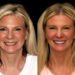 Veneer 49, full mouth and smile 63