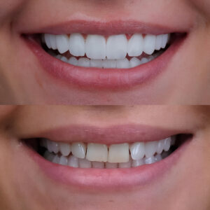 before and after of a full smile reconstruction
