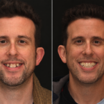invisalign 12