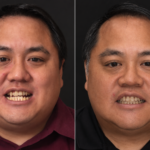 invisalign 13